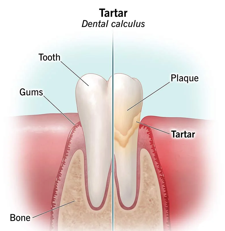 Tartar