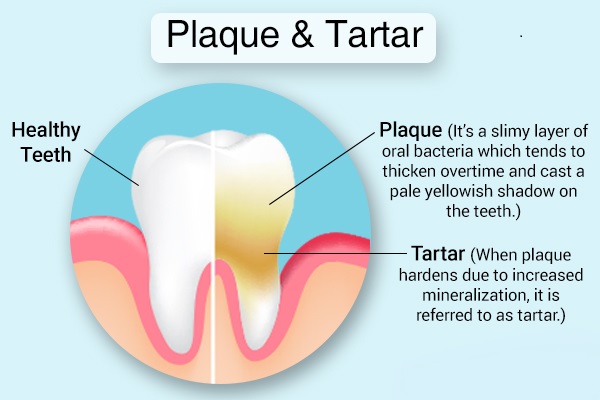 Plaque & Tartar