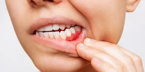 Are gum disease contagious?
