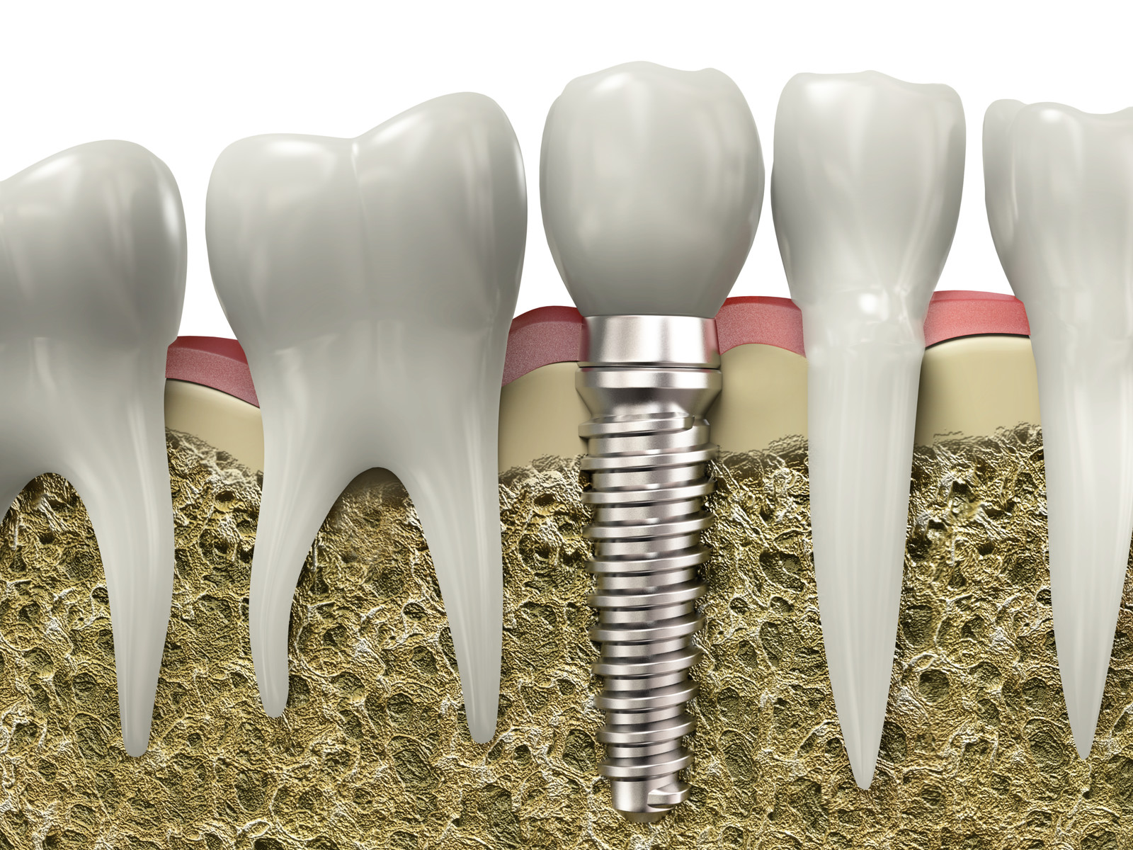 Why Dental Implants Is The Best?