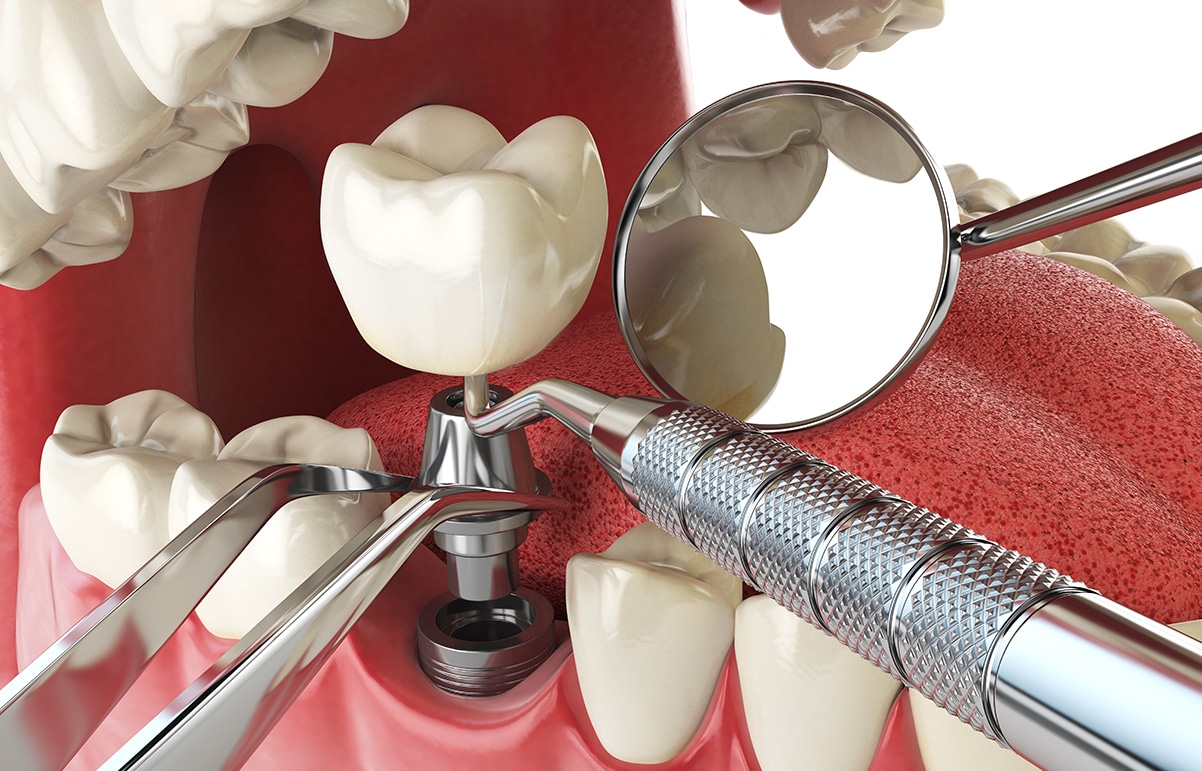 How Dental Implants Work?