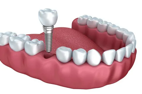 Dental Implants vs. Dentures: Which Is the Better Long-Term Investment?