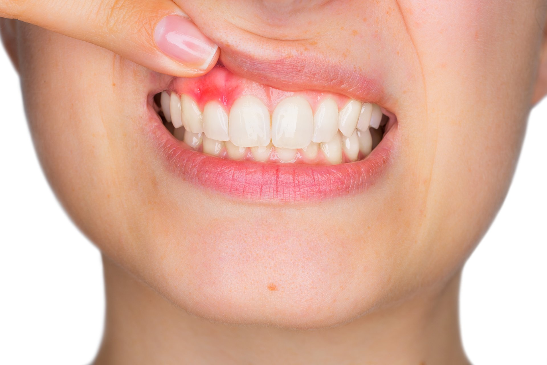 Who Are More Prone To Gum Diseases?