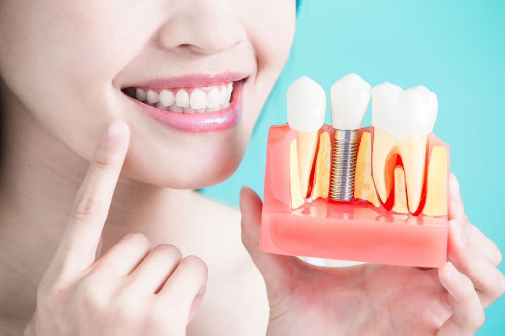 The Dental Implant Healing Process