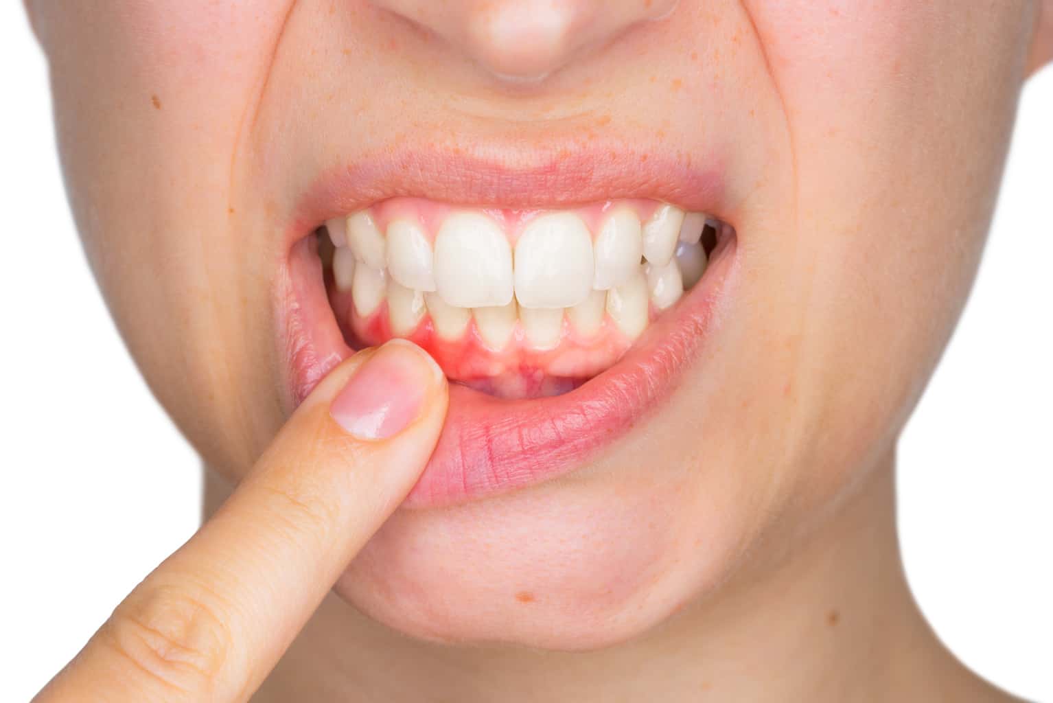 The Role of Nutrition in Gum Disease Prevention