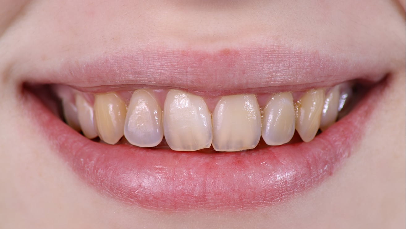 Causes Of Tartar in The Teeth