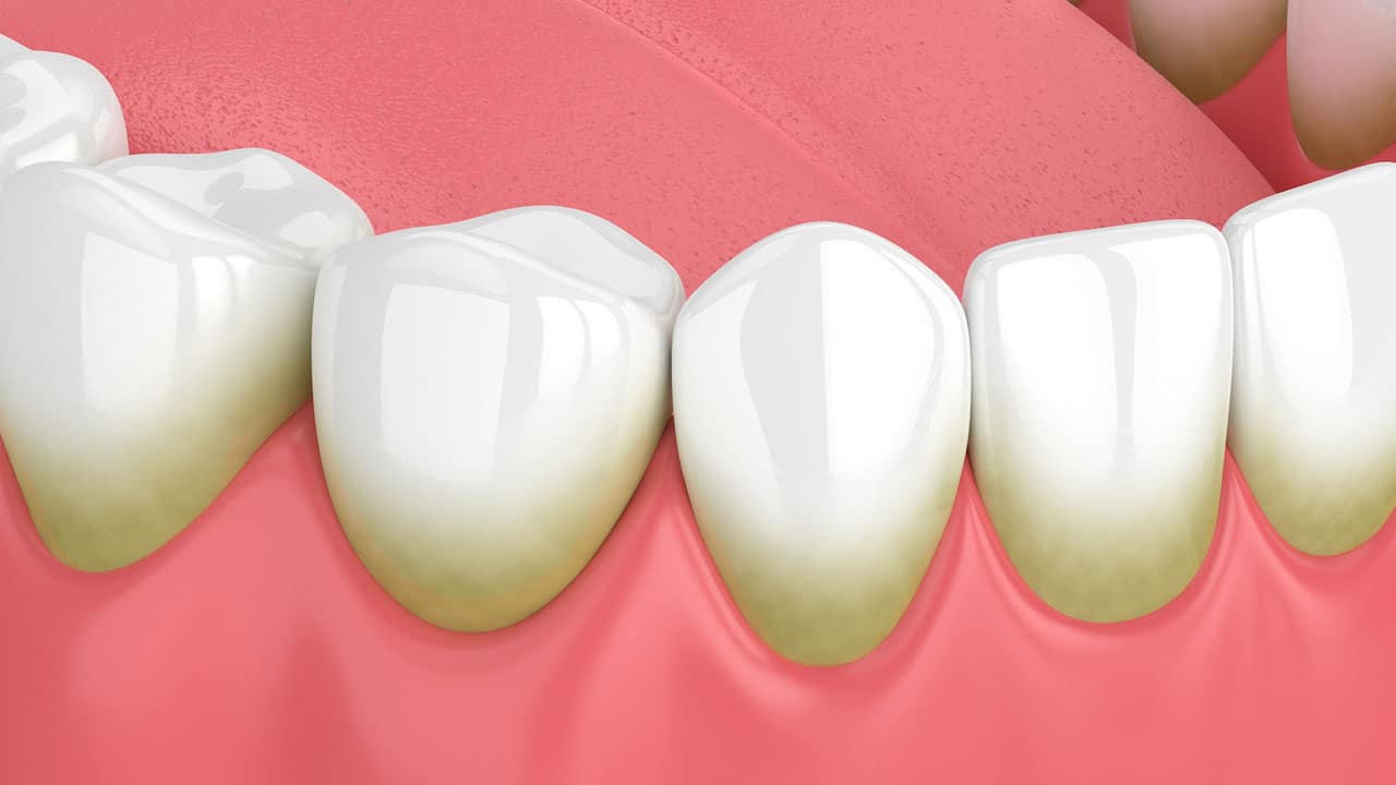 Tartar for teeth, do’s and dont’s